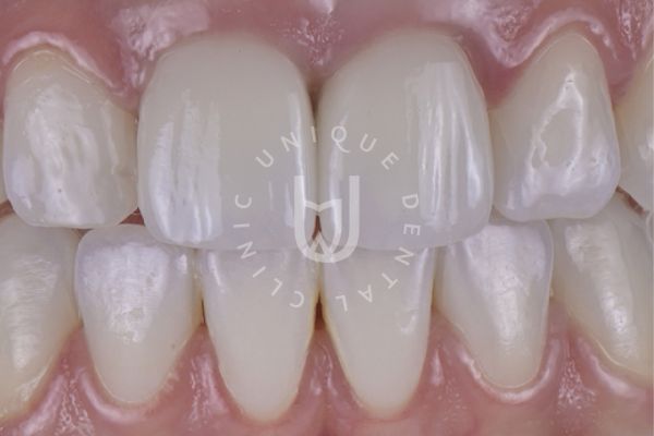 Porcelain Veneers in Cabo San Lucas with digital smile design