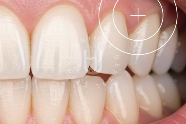 Gum Graft