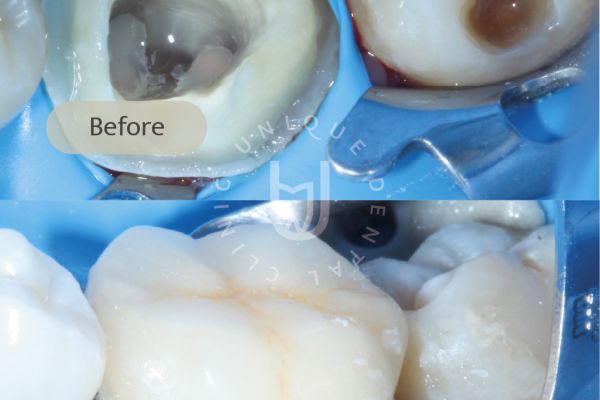 Zirconia restorations