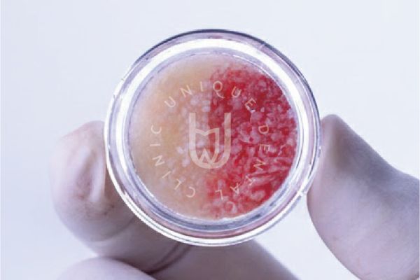 Bone regeneration
