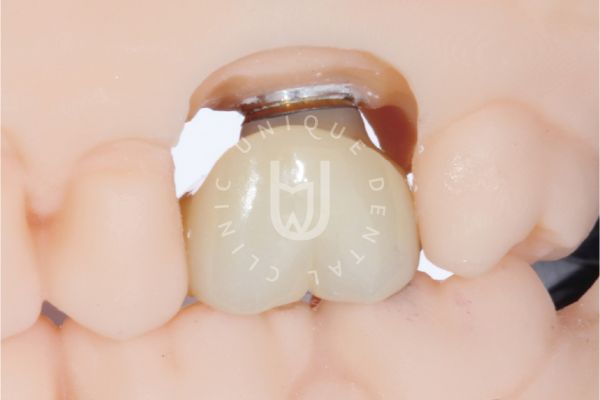 single-tooth-replacement-los-cabos