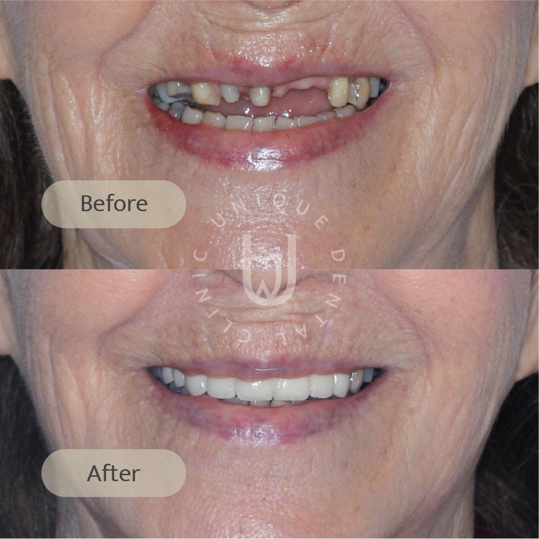 Full Mouth Rehabilitation