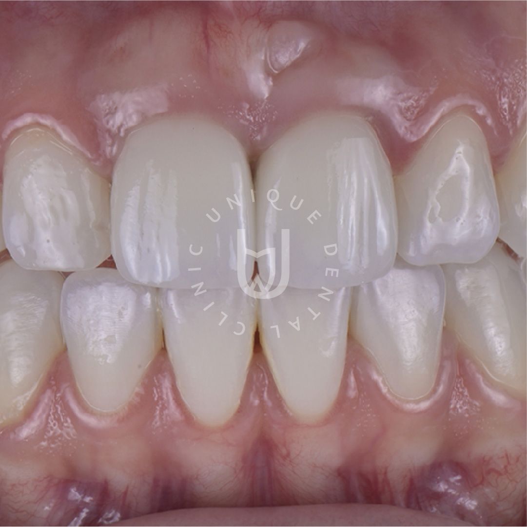 High-Tech Porcelain Veneers