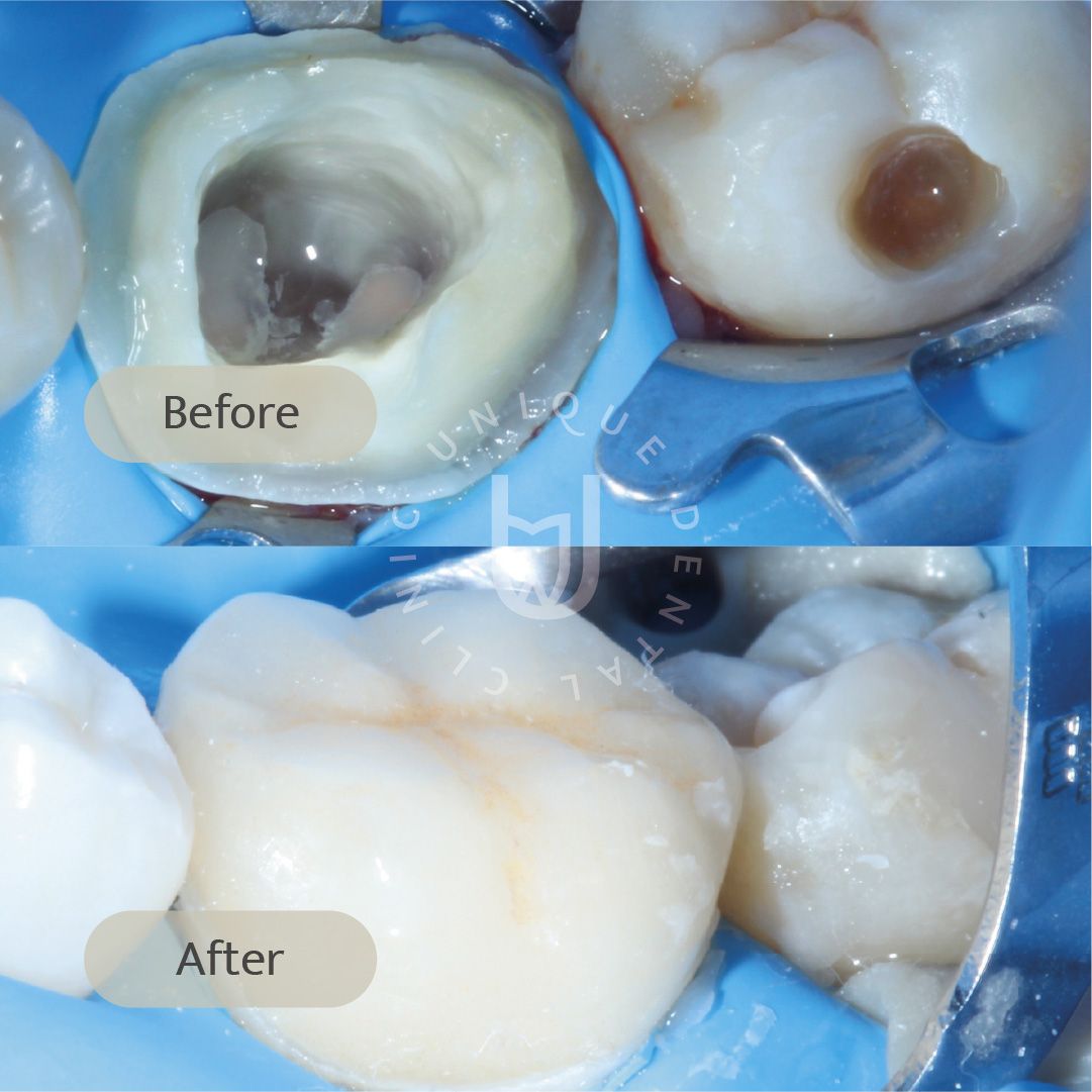 Zirconia restorations