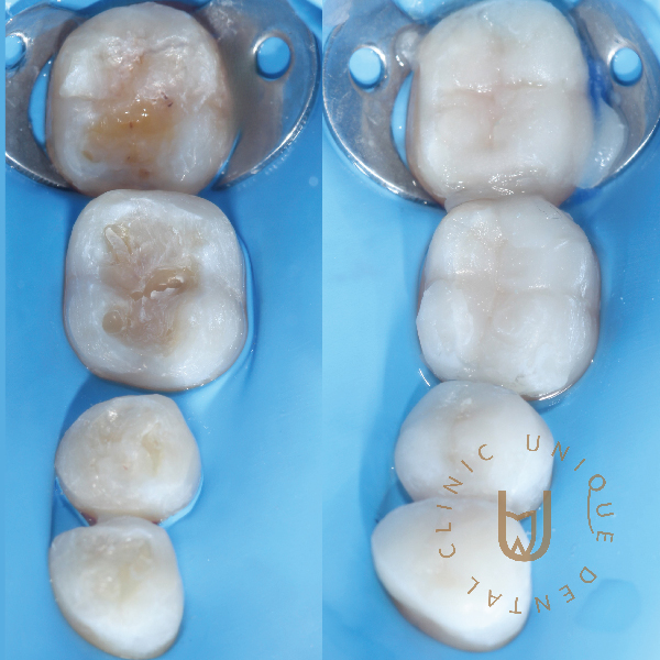 Before and After Teeth Whitening Results