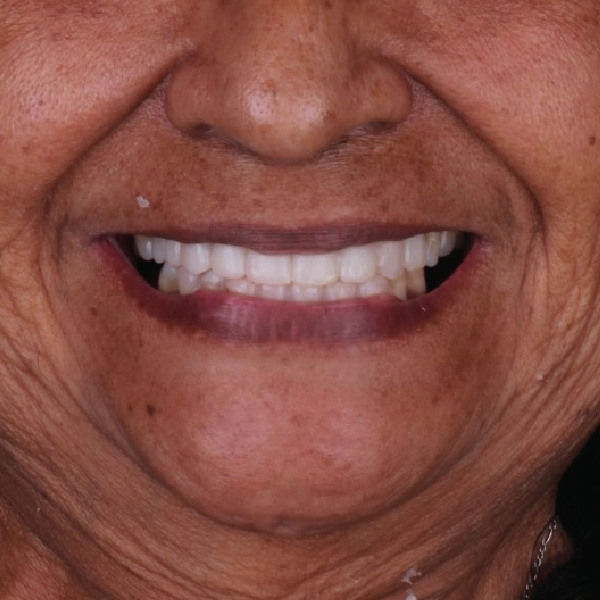 Before and After Teeth Whitening Results