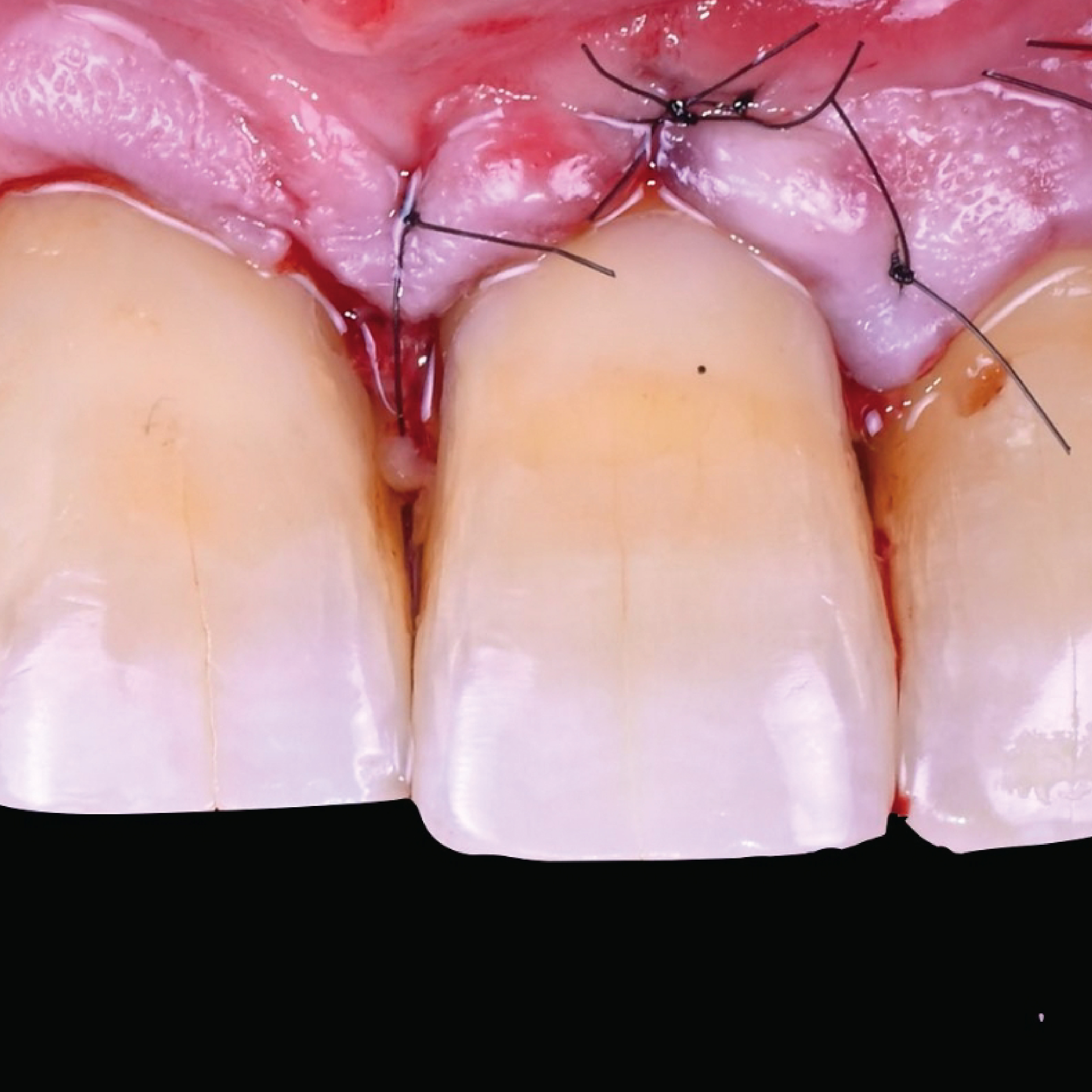 Before and After Teeth Whitening Results