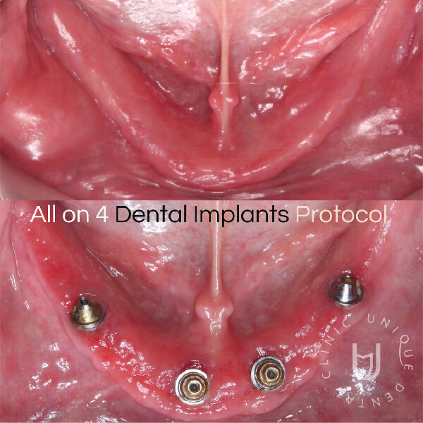 Full Arch Implant All on 4 Protocol