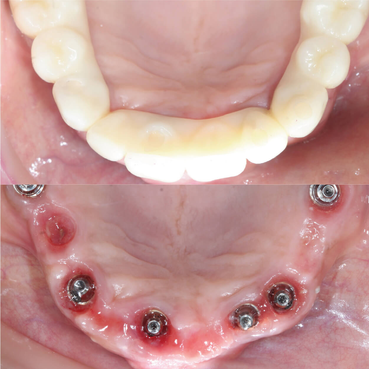 Full arch All-on-X dental implants in Cabo San Lucas