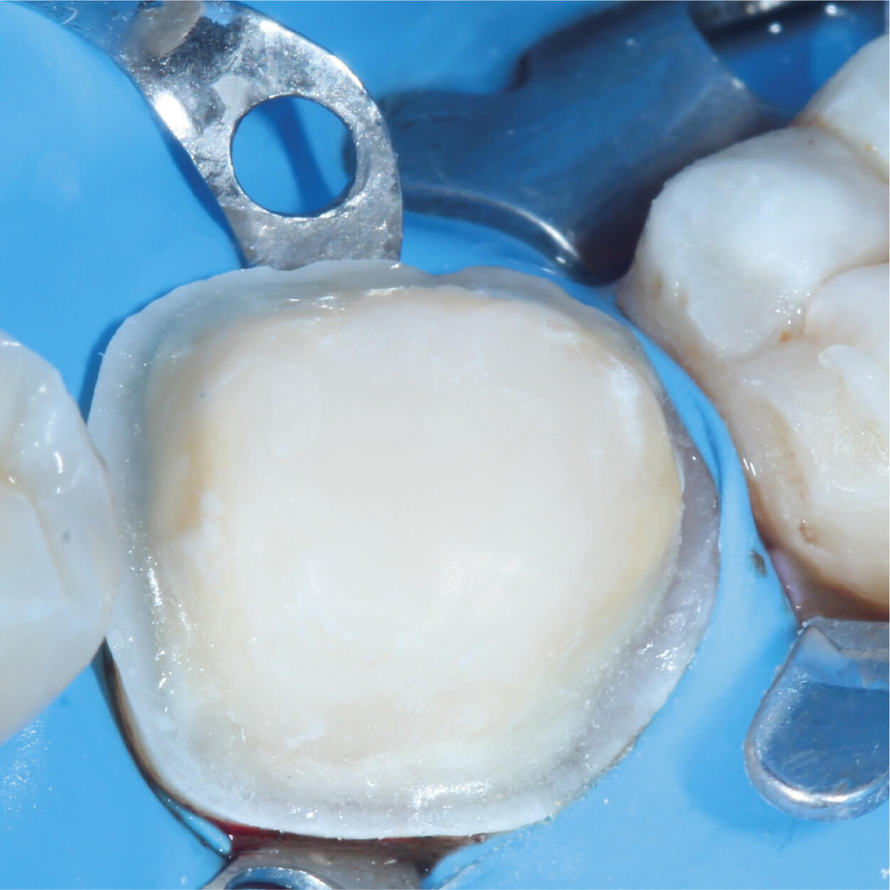 Biomimetic dental restorations preserving natural tooth structure
