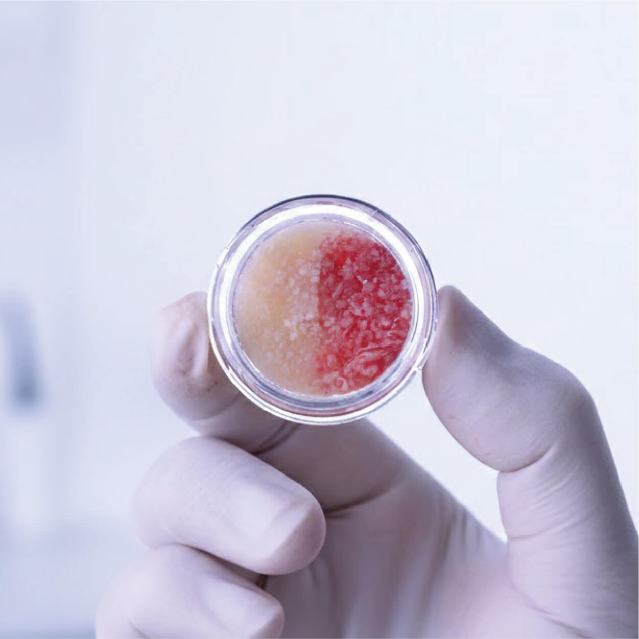 Bone regeneration procedure before dental implants in Cabo San Lucas