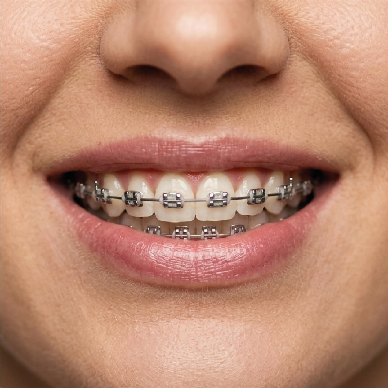 Traditional braces orthodontic treatment in Cabo San Lucas