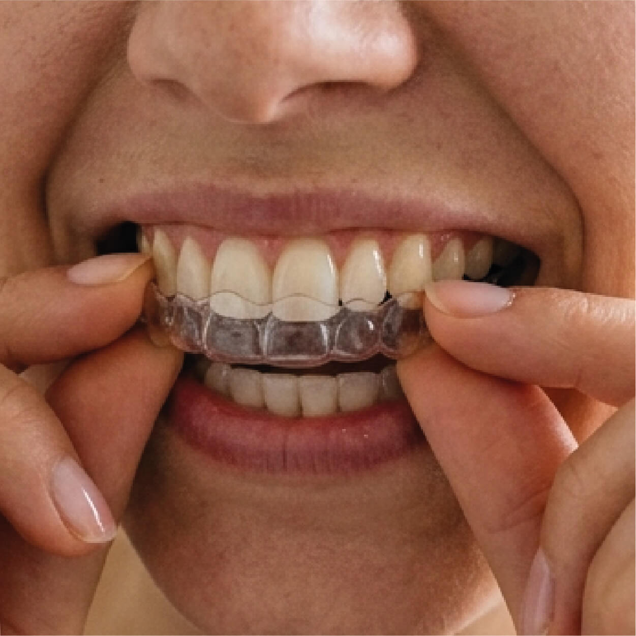 Clear aligners for discreet teeth straightening in Los Cabos