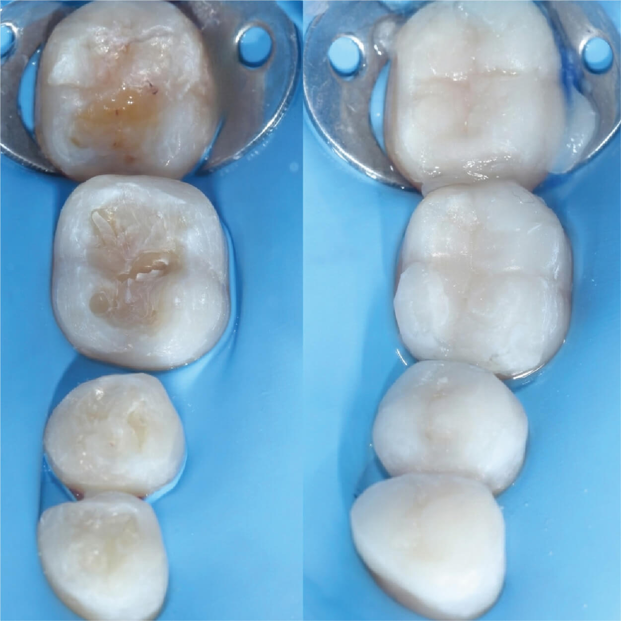 Composite fillings treatment at Unique Dental Clinic in Cabo San Lucas