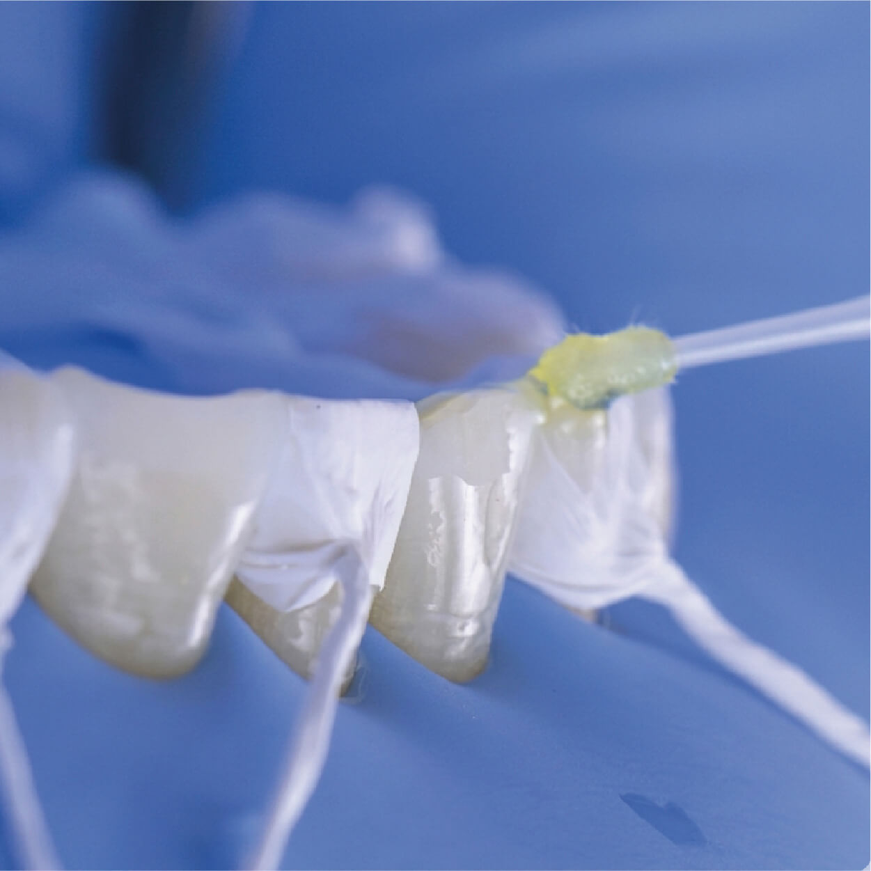 Composite veneers smile enhancement in Los Cabos