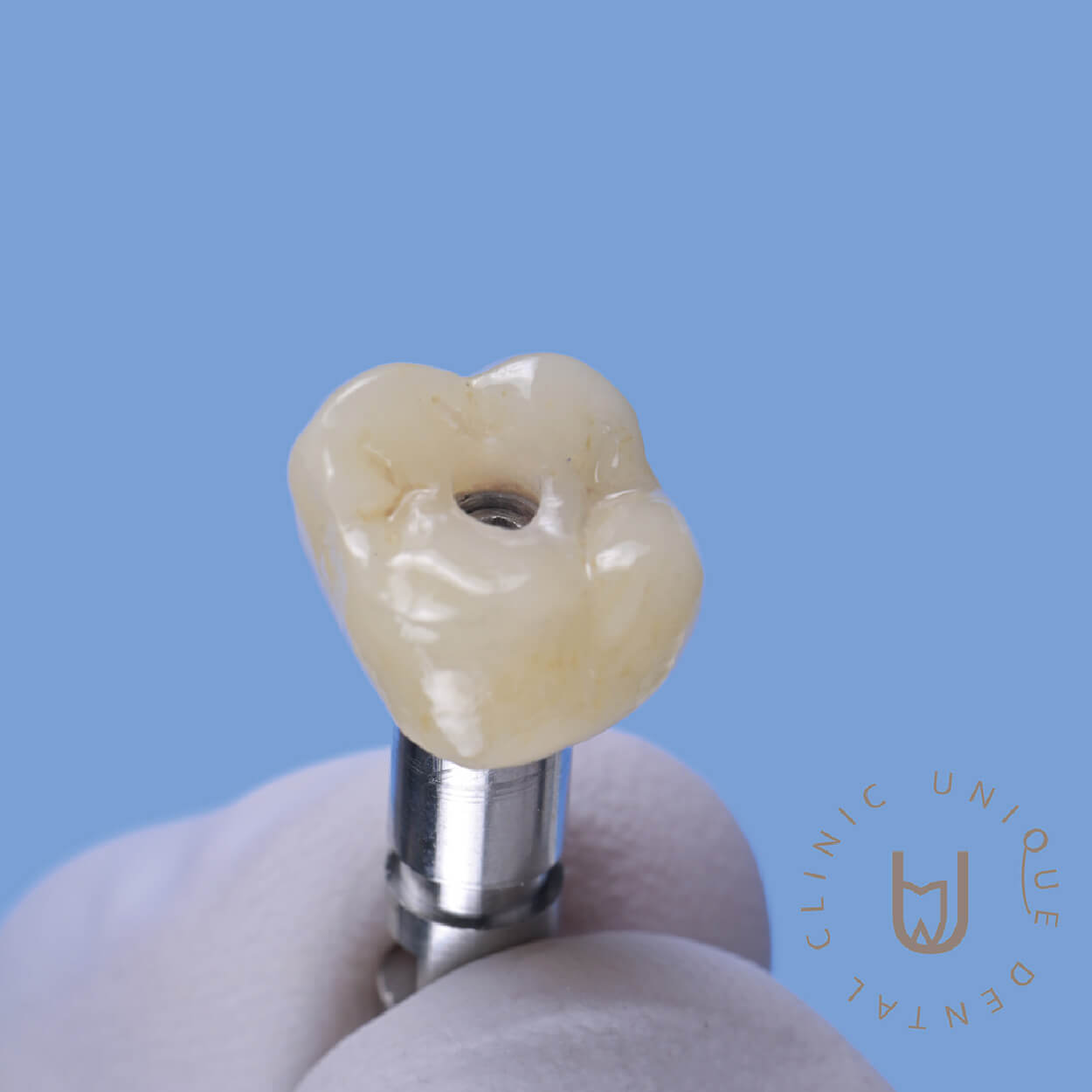 Single dental implant replacement in Cabo San Lucas
