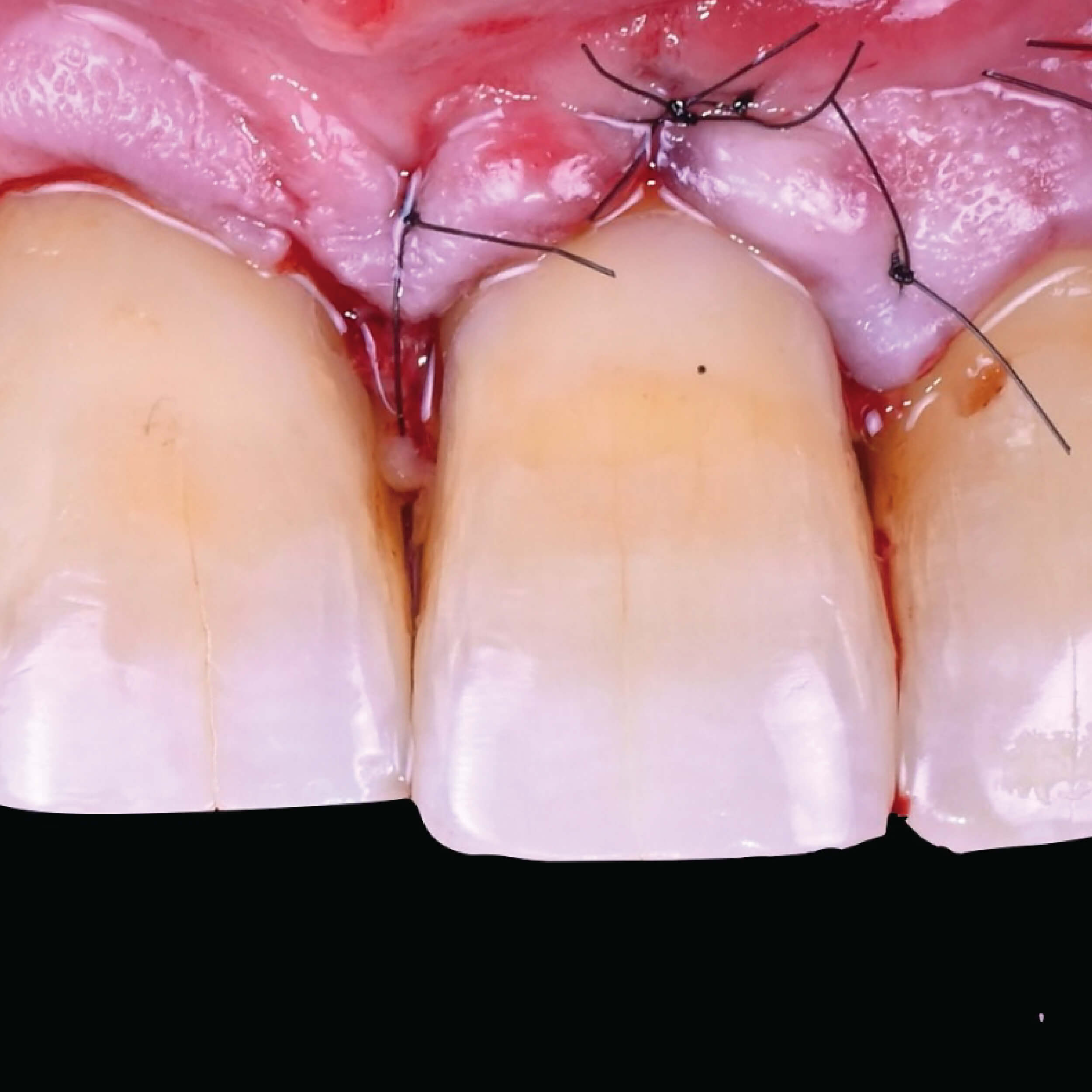 Gum graft treatment to restore receding gums in Los Cabos