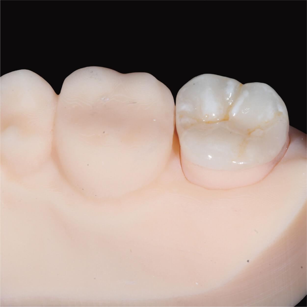 Partial dental restorations for damaged teeth in Cabos San Lucas