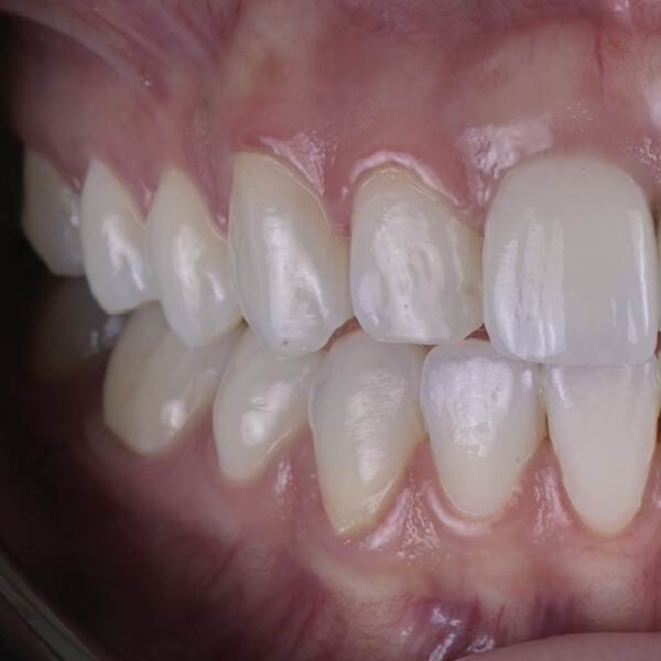 High-quality porcelain veneers smile transformation in Cabo San Lucas