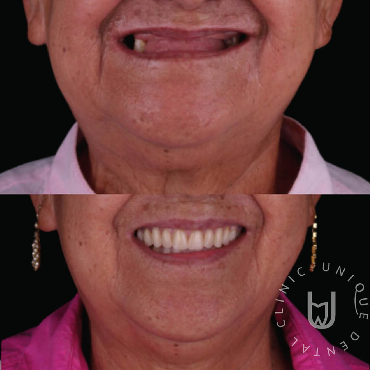 Conventional removable dentures for missing teeth in Cabo San Lucas