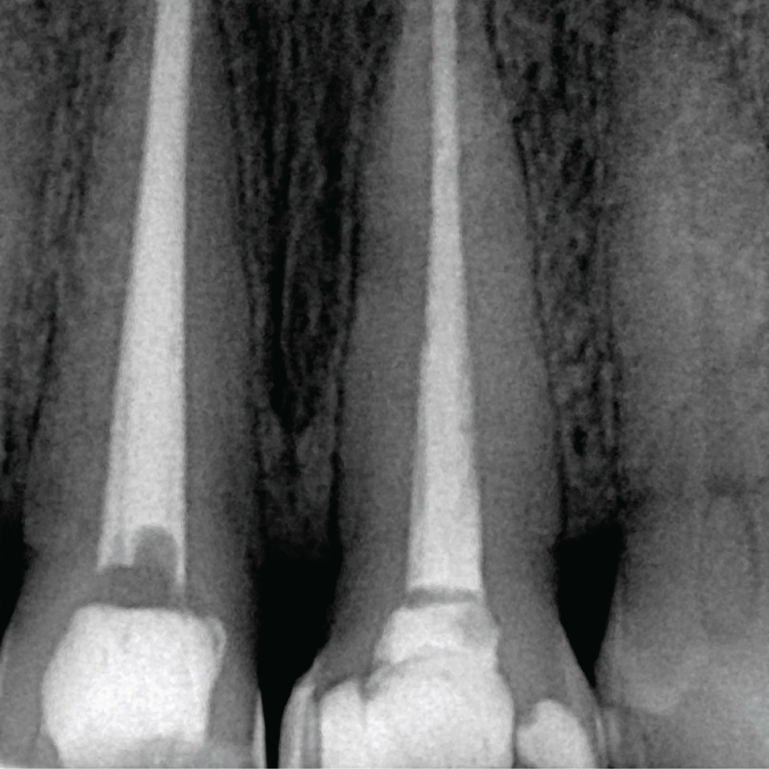 Root canal therapy performed by experienced dentist in Cabos San Lucas
