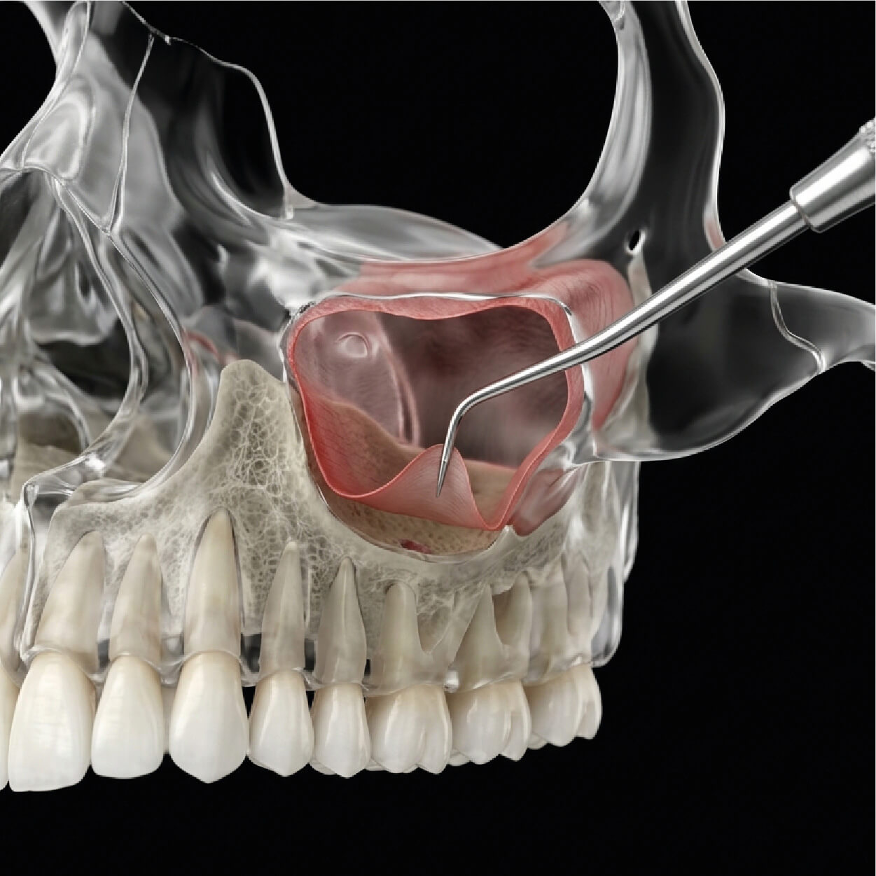 Sinus lift procedure for implant preparation in Cabo San Lucas