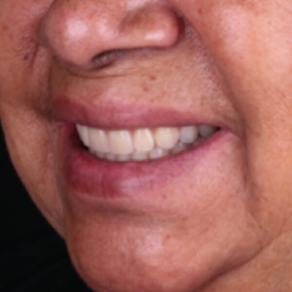 Snap-on denture supported by dental implants in Los Cabos
