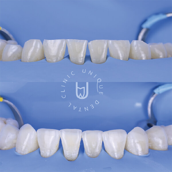 Professional teeth whitening treatment in Los Cabos