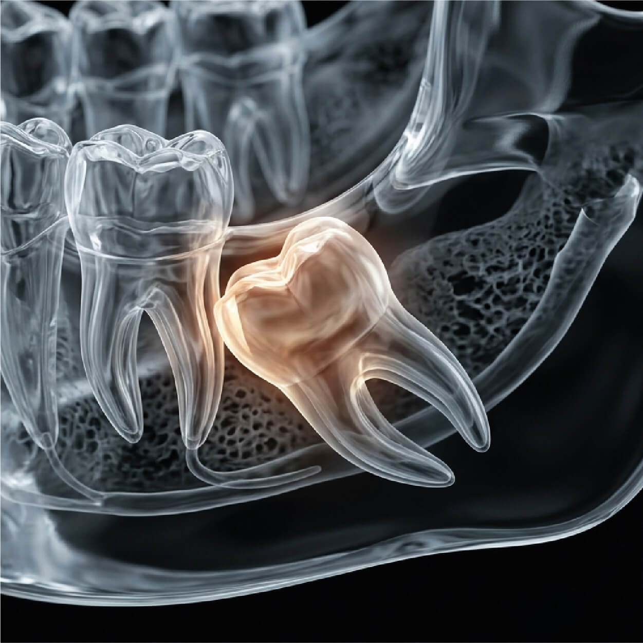 Wisdom teeth extraction performed in Los Cabos