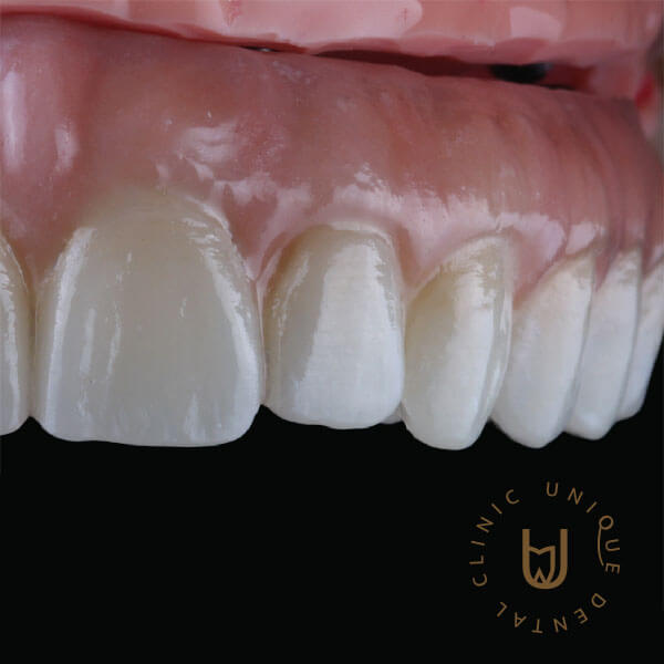 Fixed zirconia implant-supported structure in Los Cabos