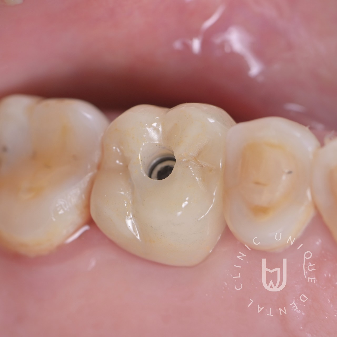 single implants designed to restore a missing tooth in Cabo San Lucas