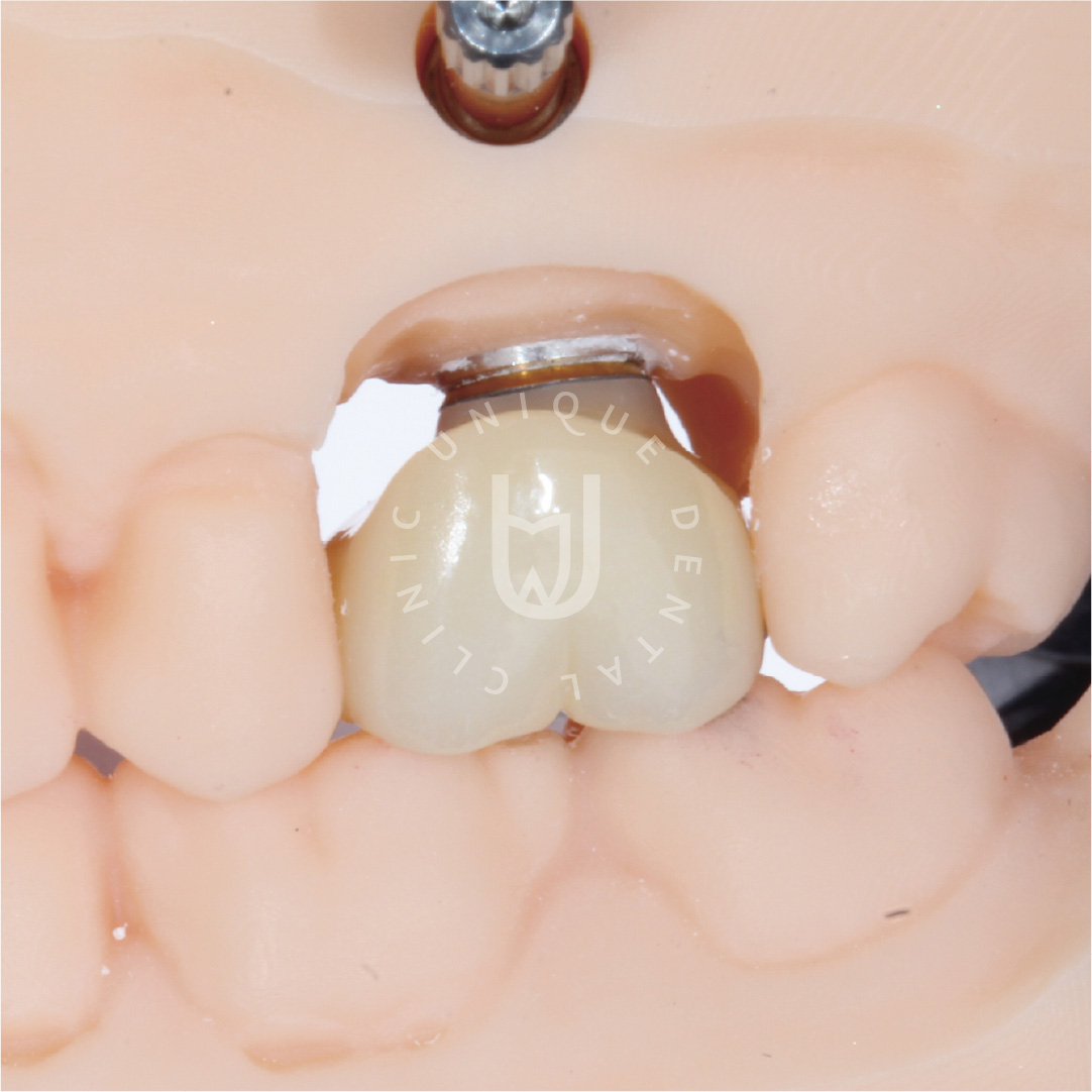 single implants restoring a missing tooth in Cabo San Lucas