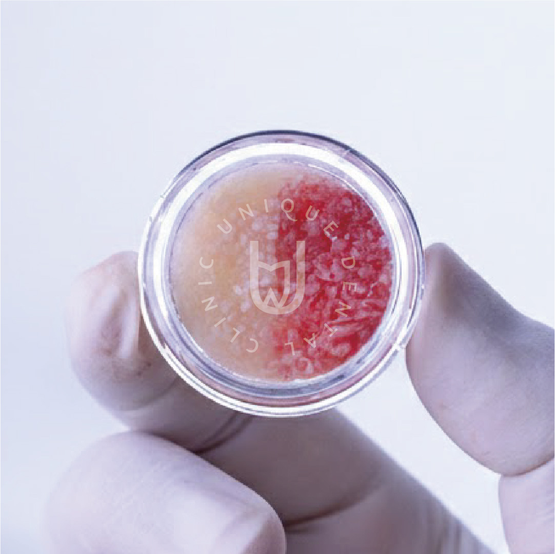 Bone regeneration