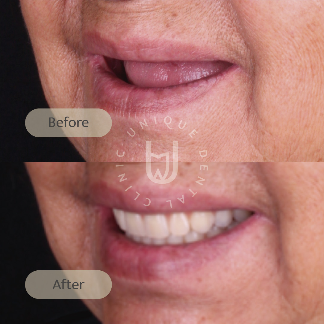 snap-on-dentures