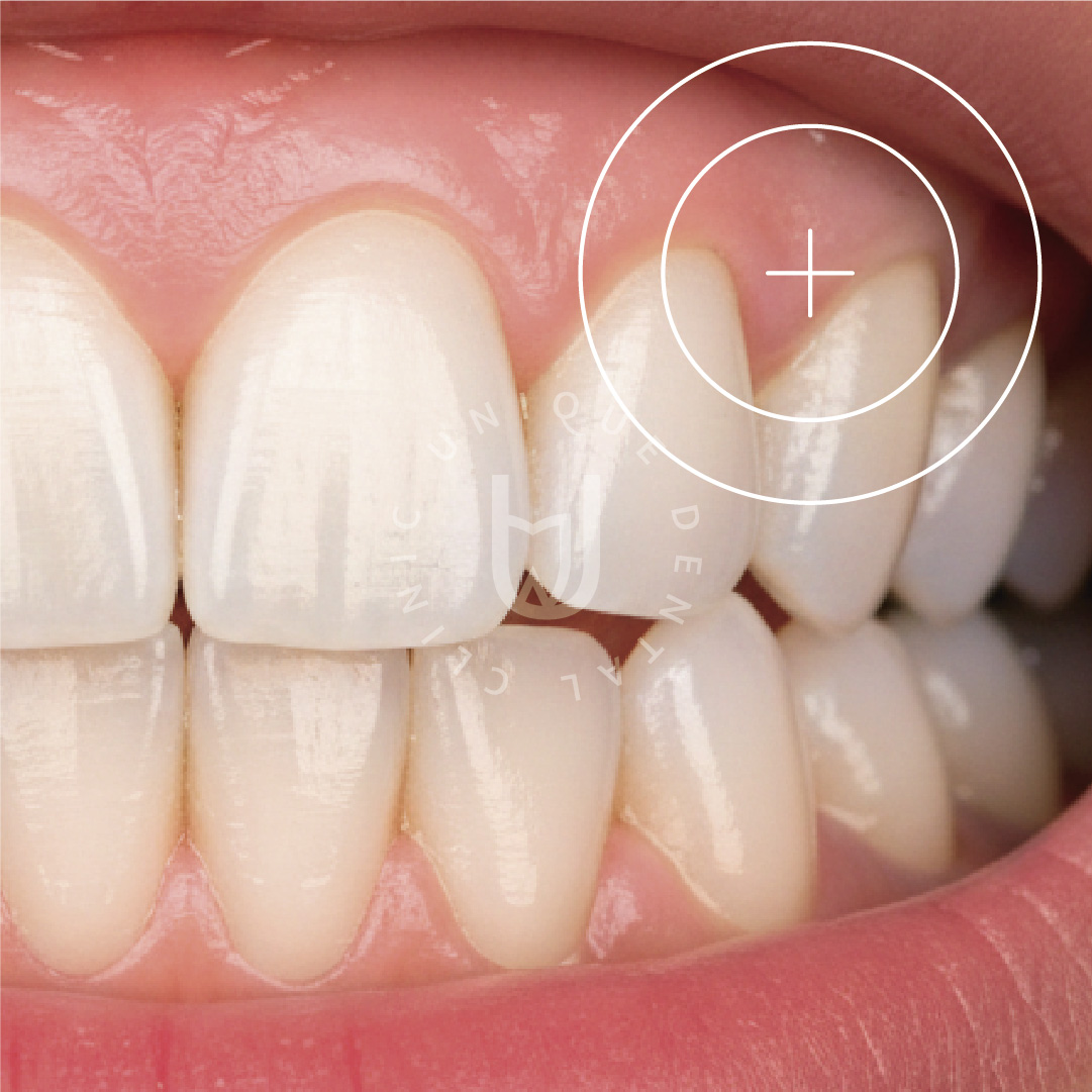 Gum Graft