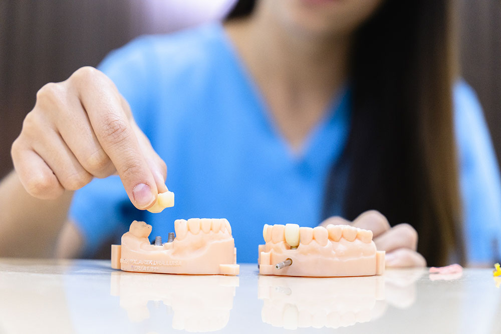single implants restoration in Cabo San Lucas