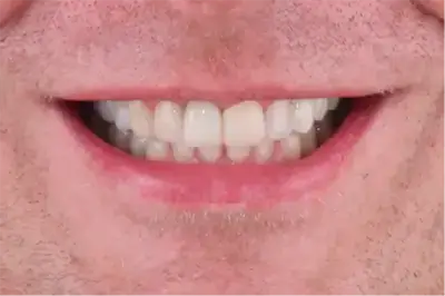 After treatment photo of a middle-aged man with a confident, premium smile achieved through high-quality dental implants in Cabo San Lucas.