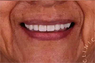 After treatment smile of a senior woman following a premium full mouth restoration at Unique Dental clinic in Cabo San Lucas.