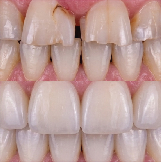 Porcelain Veneers Cabo San Lucas