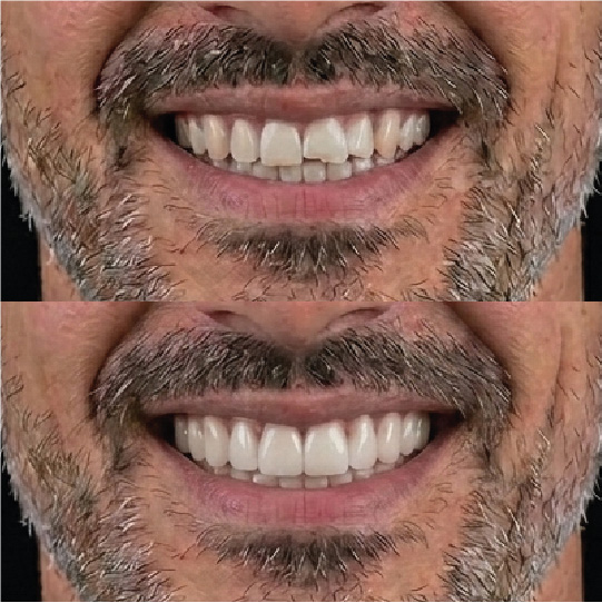 Porcelain Veneers