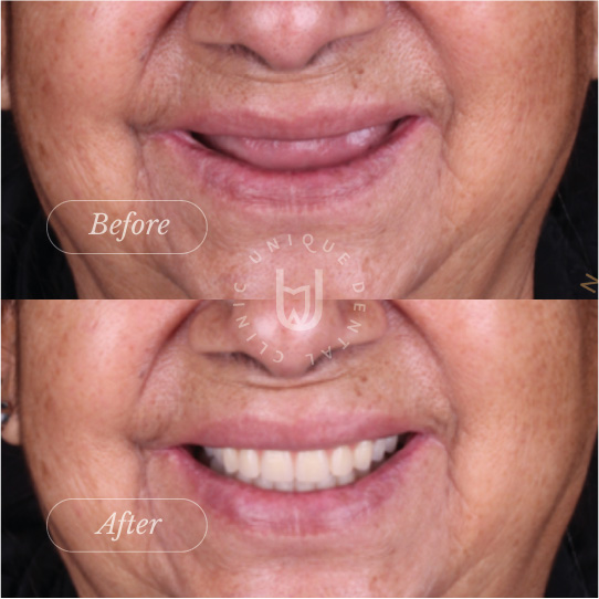 Full Arch Implant Restoration