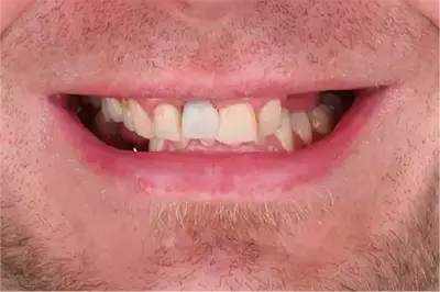 Before treatment smile showing missing teeth of a middle-aged man visiting Unique Dental clinic in Cabo San Lucas.