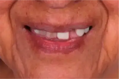 Before treatment view of a senior woman requiring a full mouth rehabilitation at Unique Dental clinic in Cabo San Lucas.
