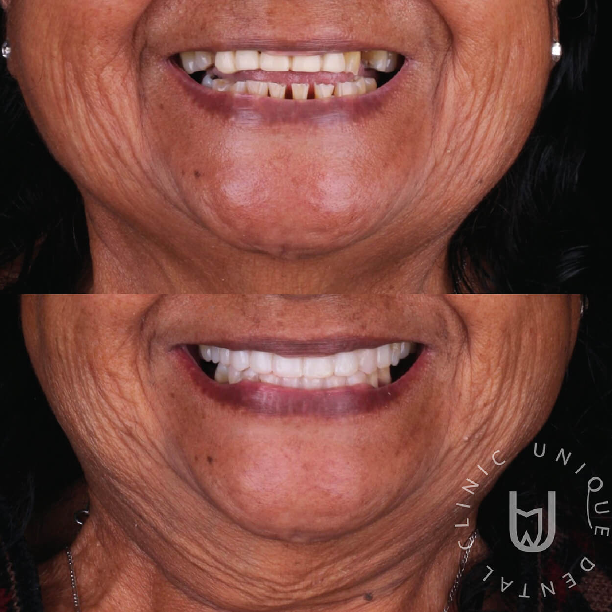 Couple smiling after smile makeover treatment in Los Cabos