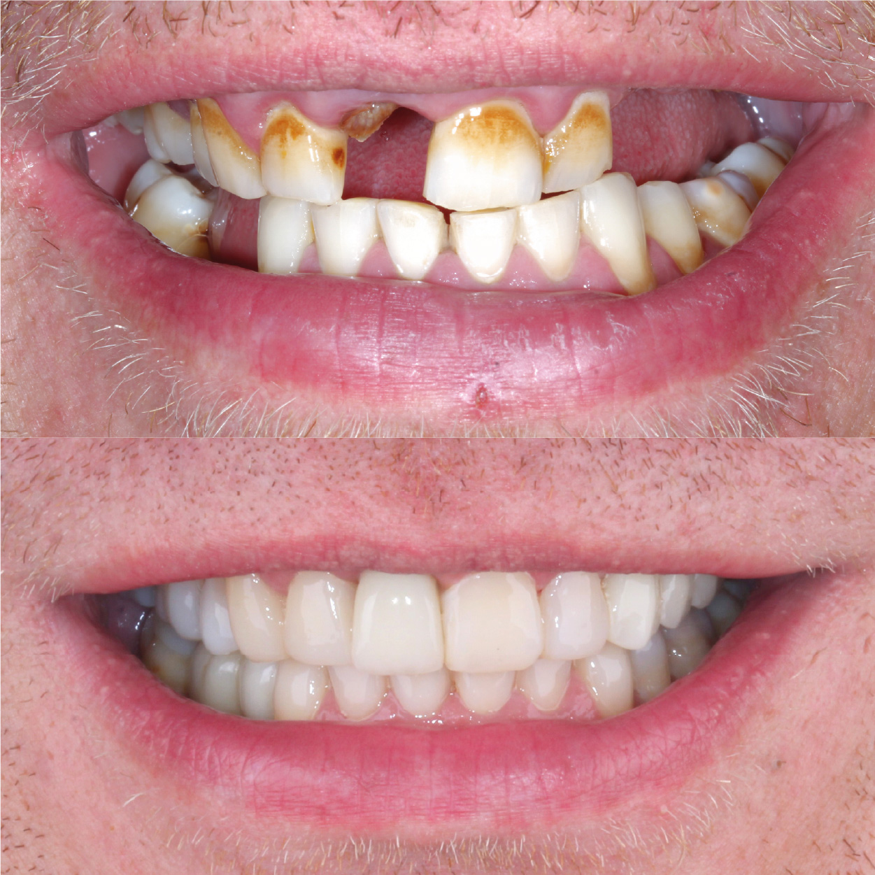 Full Mouth Rehabilitation before and after los cabos san lucas
