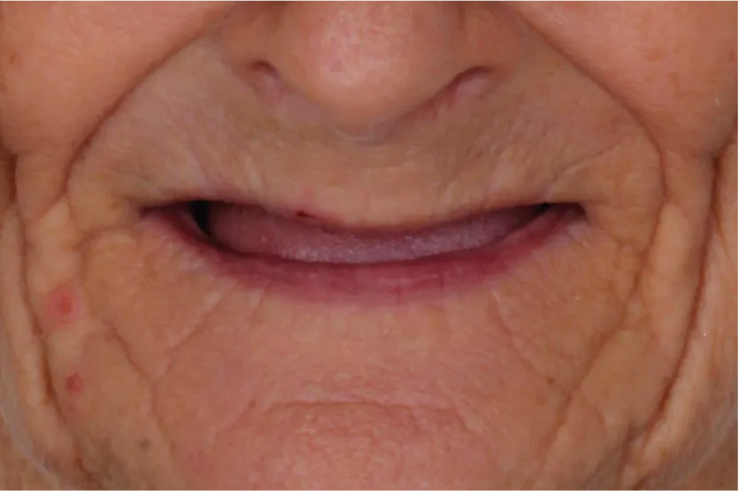 Before treatment view of a senior woman requiring a full mouth rehabilitation at Unique Dental clinic in Cabo San Lucas.