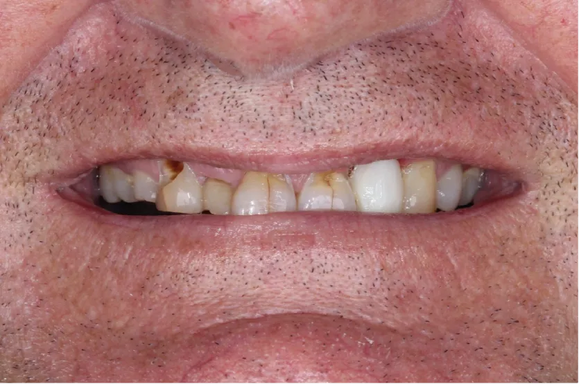 Before treatment smile showing missing teeth of a middle-aged man visiting Unique Dental clinic in Cabo San Lucas.