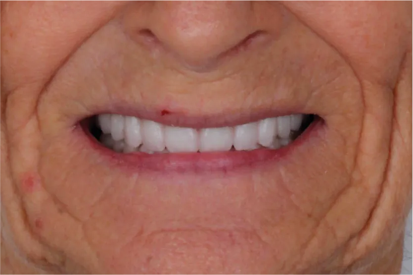 After treatment smile of a senior woman following a premium full mouth restoration at Unique Dental clinic in Cabo San Lucas.