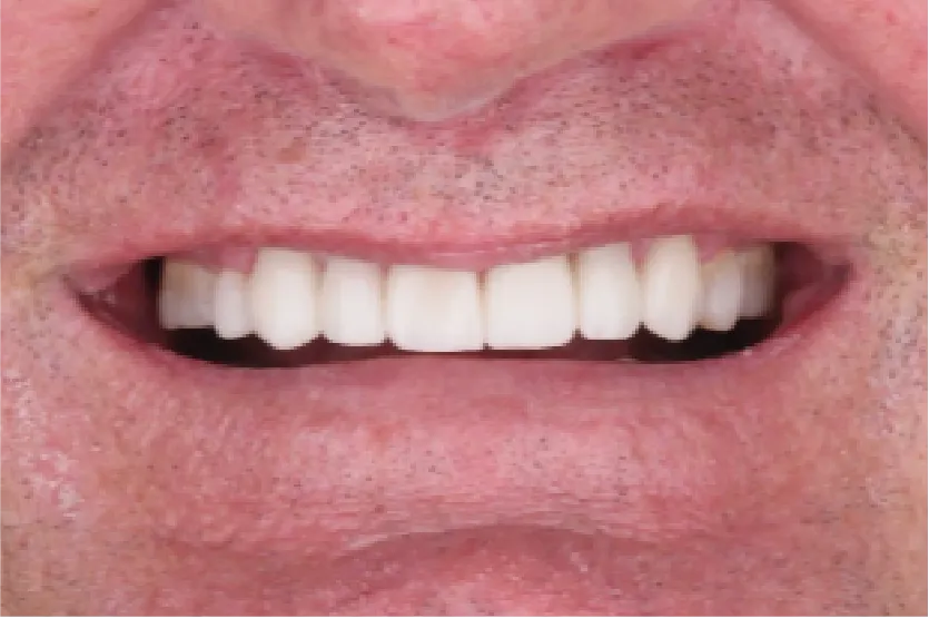 After treatment photo of a middle-aged man with a confident, premium smile achieved through high-quality dental implants in Cabo San Lucas.