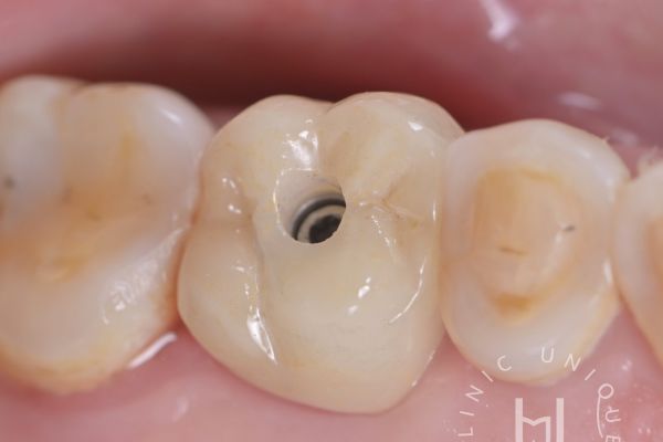Implant-supported crown designed to restore a missing tooth in Cabo San Lucas
